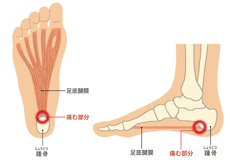 足底腱膜炎