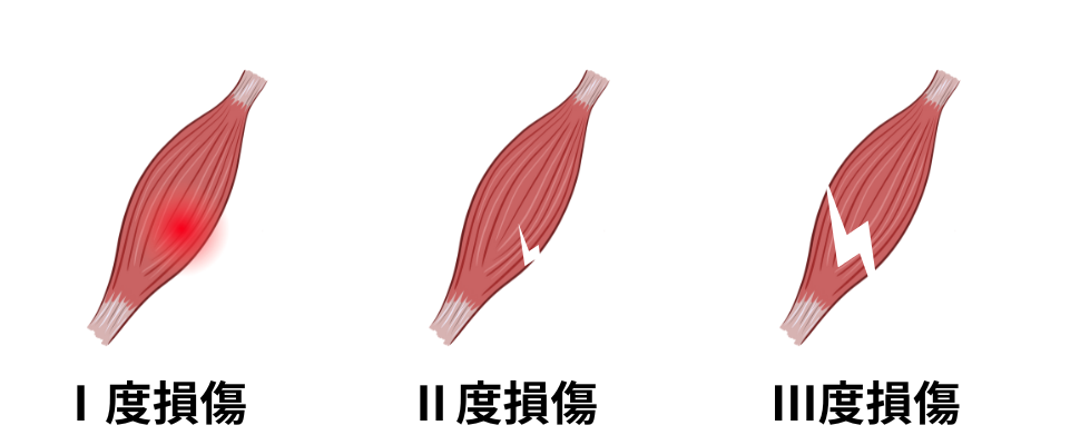 肉離れ重症度