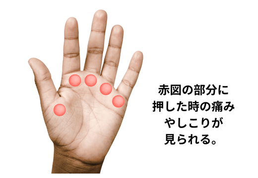 ばね指の痛み