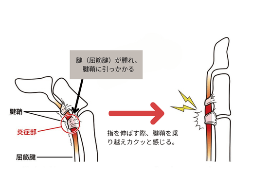 ばね指の病態