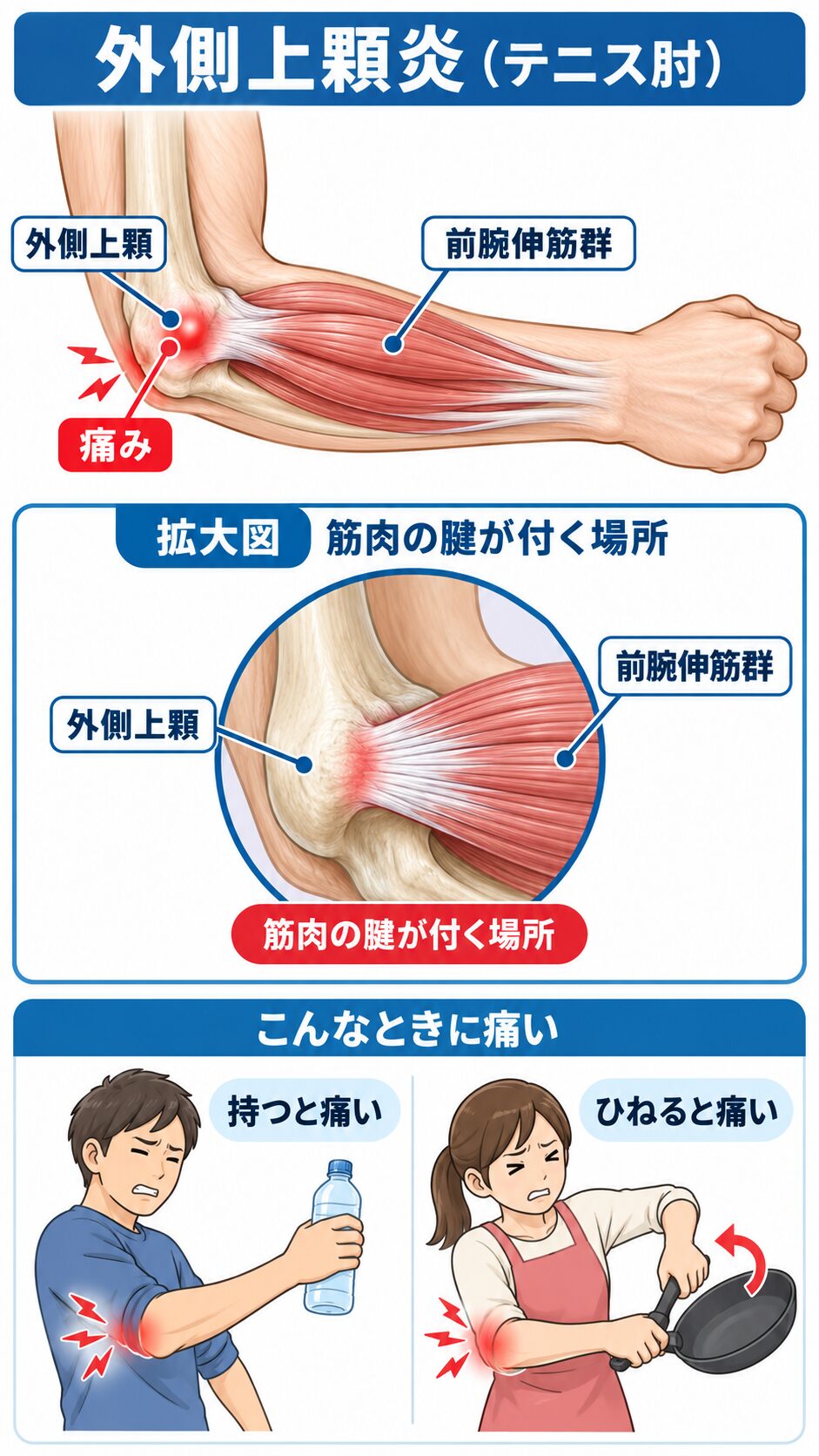 テニス肘で痛みが出る上腕骨外側上顆と前腕伸筋群の位置
