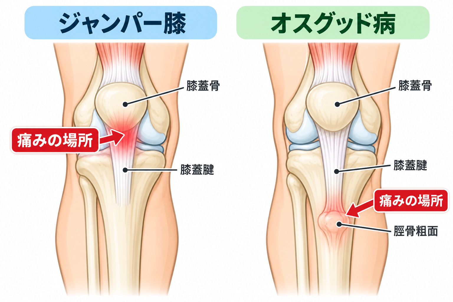 ジャンパー膝とオスグッド病の痛む場所の違い(左は膝のお皿のすぐ下、右はすねの骨の出っぱり)