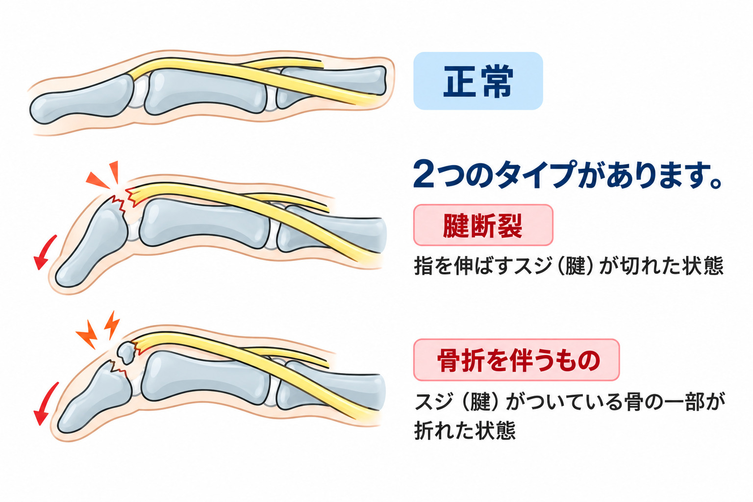 正常な指と、腱が切れたマレット指、骨折をともなうマレット指の比較