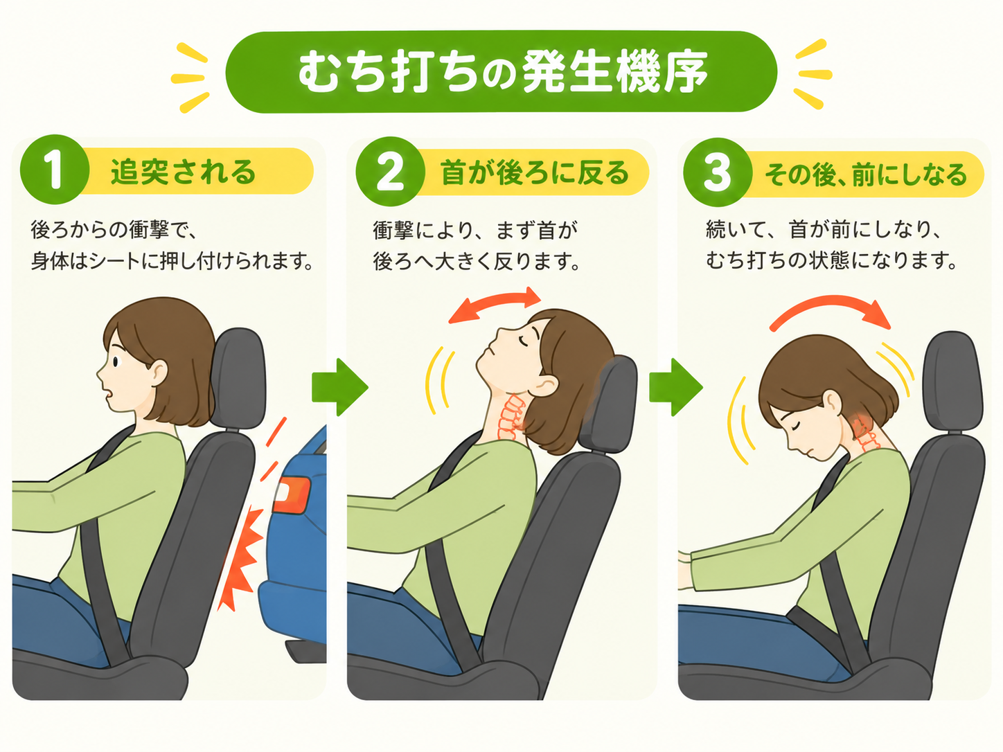 追突の衝撃で首が後ろから前へ大きくしなり、むち打ちが起こる様子
